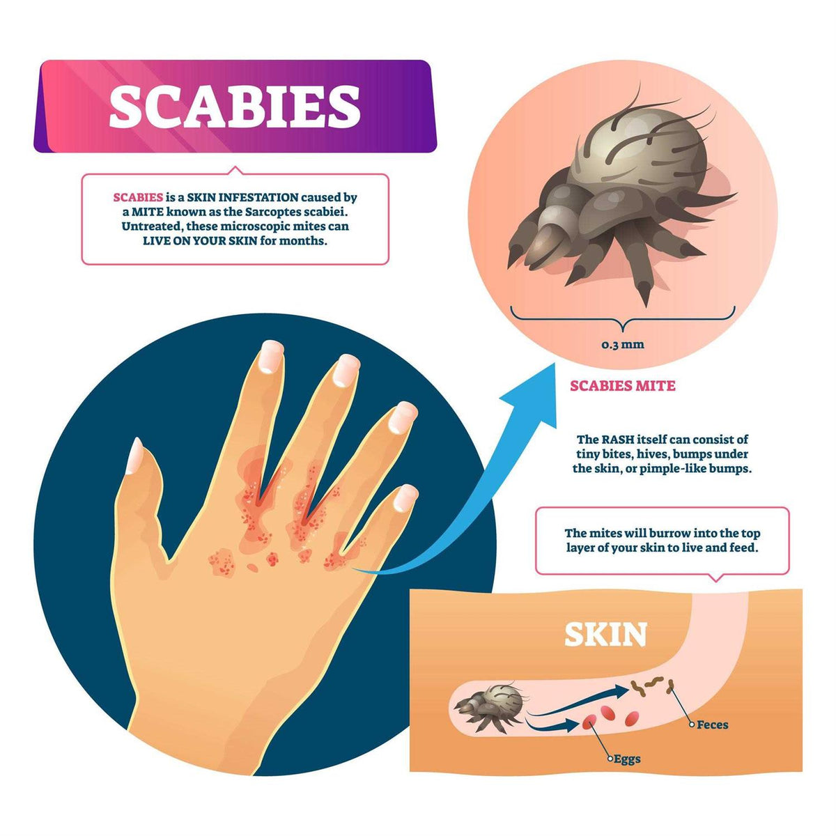 Scabies Cream N474760
